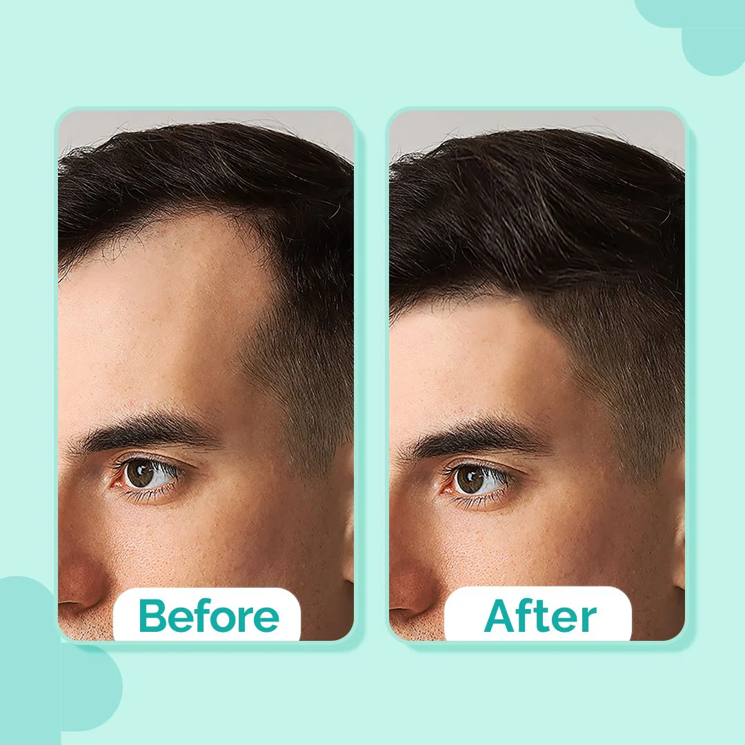 20% Actives Peptide-Stem Cell Hair Growth Serum with Foligen Analupe & Anagain For Hair Growth - 30 ml - Image 3